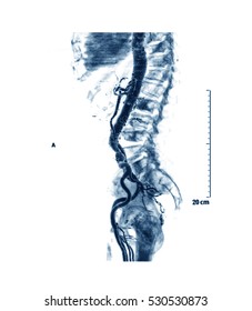 Computed Tomography Angiography (CTA) Of Abdominal Aorta, Right Lateral View.