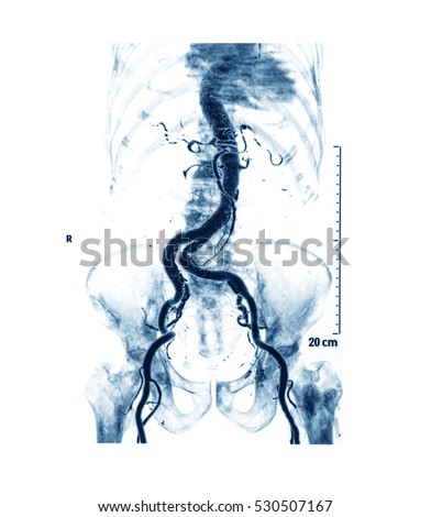 Computed tomography angiography (CTA) of abdominal aorta, antero-posterior (AP) view.