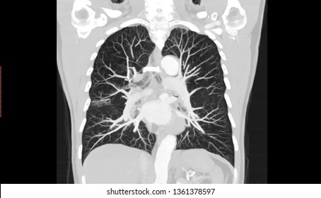 Computed Tomography Angiography (CTA)  Scan  Of Chest And Abdomen