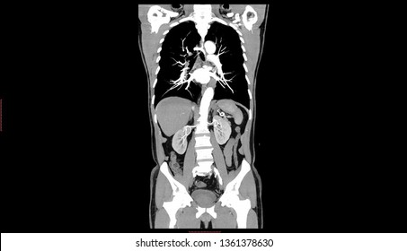 Computed Tomography Angiography (CTA)  Scan  Of Chest And Abdomen