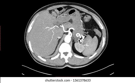 Computed Tomography Angiography (CTA)  Scan  Of Chest And Abdomen