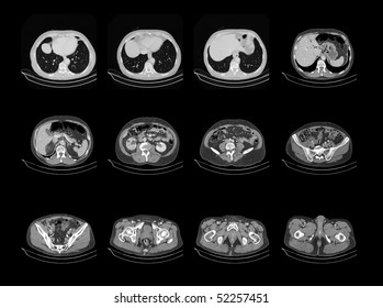 Computed Tomography Of Chest And Abdomen, Ct Scan