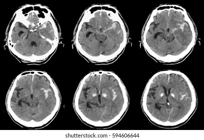 Computed tomography (CT) of brain :  Left SAH (Subarachnoid hemorrhage)