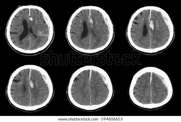 脳のct Computed Tomography 左側sdh 硬膜下血腫 と実質内出血 の写真素材 今すぐ編集