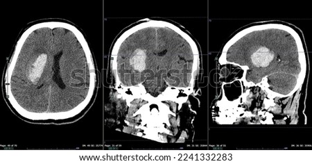 Computed tomography (CT) of brain: Massive right intraventricular hemorrhage from hemorrhagic stroke. The patient had history of uncontrolled high blood pressure.
