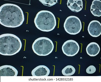 Computed Tomography (CT) Of The Brain Showing Brain Abscess.