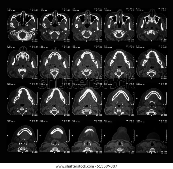 Computed Tomography Ct Dental Mandible Case Stock Photo 613599887 ...