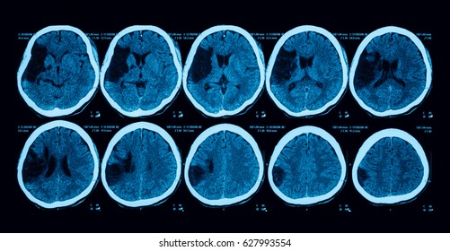 Computed Tomography (CT Scan) Of The Brain, Case Of Old Cerebrovascular Accident (CVA), Left Hemiparesis