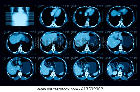 Computed tomography (CT) of upper abdomen, case of liver abscess, a 58 year old male 