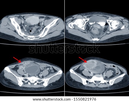 Computed Tomography (CT)WHOLE ABDOMEN.There is a 9cm diameter oval mass at mid pelvic cavity.Medical image concept.