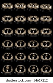 Computed Tomography Of Heart, Lungs And Mediastinum