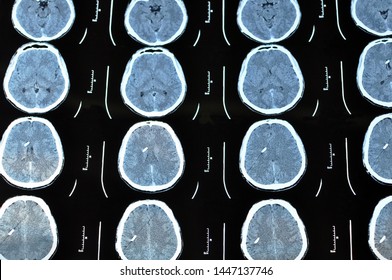 Computed Tomography Image Scan Of The Brain. CT Film Of A Human Skull And Brain With Intracranial Shunt. Neurology Background. Medicine, Science.