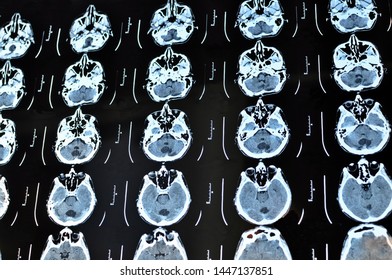 Computed Tomography Image Scan Of The Brain. CT Film Of A Human Skull And Brain With Intracranial Shunt. Neurology Background. Medicine, Science.