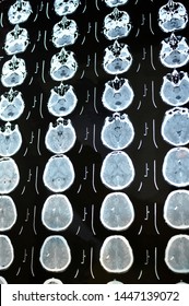 Computed Tomography Image Scan Of The Brain. CT Film Of A Human Skull And Brain With Intracranial Shunt. Neurology Background. Medicine, Science, Vertical View.