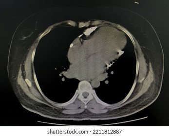 Computed Tomography Scan (CT Scan) Of Cardiac