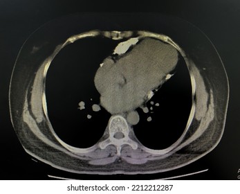 Computed Tomography Scan (CT Scan) Of Cardiac