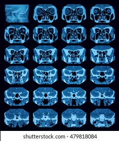 Computed Tomography Scan (CT Scan) Of Maxillary Sinusitis