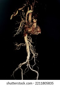 Computed Tomography scan (CT scan) of patient who has aortic dissection type A