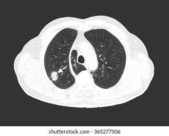 Computed Tomography Scan Showing Malignant Tumor In The Lung (marked By Arrow) In A Heavy Smoker Male Patient