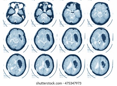 Computed Tomography(CT) Of Brain, Brain Abscess,