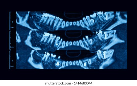 Computed Tomography(CT-scan) Of Human Dental