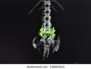 Computer Tomography 3D Reconstruction CT Image Of Lumbar Spine Showing Spinal Fusion At L4 To L5 Level After Lumbar Spine Surgery. 