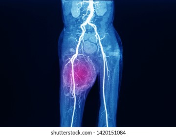 An Computer Tomography Or CT Image With Angiogram Showing Aorta And Artery With Feeding Vessel To A Large Cancer At Right Thigh. The Patient Need Surgery. Red Highlight Focus On The Tumor.