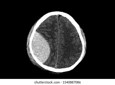 A Computer Tomography Or CT Image Of Brain Showing Massive Epidural Hemorrhage Or Hematoma With Mass Effect. The Patient Needs Emergent Surgical Craniectomy To Remove The Hematoma.
