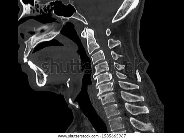 Computer tomography or\
CT scan of cervical spine showing ossified posterior longitudinal\
ligament or OPLL at C5 and C6 level. The pathology causes\
myelopathy and neck pain.\
