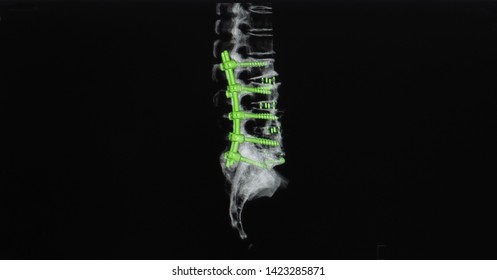 Computer Tomography Or CT Scan Image Of Spine Showing Pedicle Screw Fixation And Decompression Surgery In Patient With Spinal Canal Stenosis. Oblique Lateral Lumbar Interbody Fusion Or OLIF.