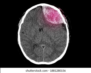 A Computer Tomography Image Of Brain And Skull Showing Large Epidural Hemorrhage Or Hemorrhagic Stroke. The Patient Has Loss Of Consciousness And Weakness. He Needs Emergent Craniectomy.