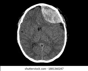 A Computer Tomography Image Of Brain And Skull Showing Large Epidural Hemorrhage Or Hemorrhagic Stroke. The Patient Has Loss Of Consciousness And Weakness. He Needs Emergent Craniectomy.