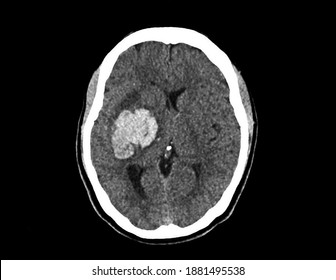 A Computer Tomography Image Of Brain And Skull Showing Large Intracerebral Hemorrhage Or Hemorrhagic Stroke. The Patient Has Loss Of Consciousness And Weakness. He Needs Emergent Craniectomy.