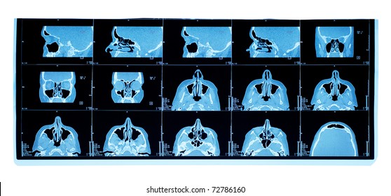 Computer Tomography Of Maxillary Sinus. Nasal Septum Deviation