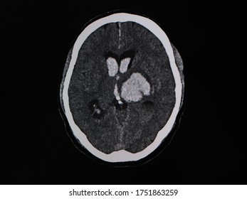 Computer Tomography Scan Showed Left Thalamic Hemorrhage With Intraventricular Hemorrhage