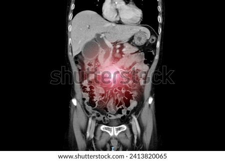 Computer tomography scan technology in surgical patient with abdominal pain.Liver mass or tumor can be detected.Cancer research medical radiology unit.Peritonitis in surgery ward.CT scan background.