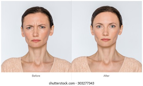 Concept Of Botox Procedure. Middle Age Woman With And Without Aging Singes - Worry Wrinkles, Nasolabial Folds Before And After Cosmetic Or Plastic Procedure, Anti-age Therapy, Lips Volume 