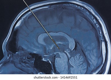 Concept of brain recording at subthalamic nucleus in parkinson surgery. Microelectrode recording on magnetic resonance imaging of human brain - Shutterstock ID 1414692551