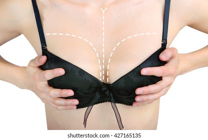 Concept of breast augmentation. Marks on a woman's breasts before surgery