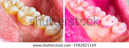 Concept of deep and detailed cleaning of the teeth. Pink disclosing tablets or gel for reveal and remove plaque and tartar. Horizontal before and after dental cleaning. Removal of yellow plaque.