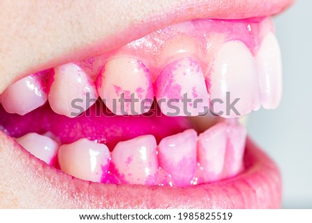 Concept of deep and detailed cleaning of the teeth. Pink disclosing tablets or gel for reveal and remove plaque and tartar. Removal of yellow plaque. Self inspection of plaque.
