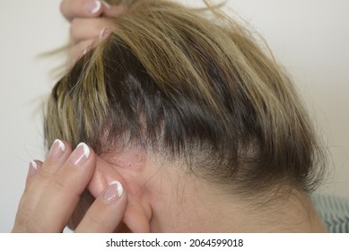 Concept: Dermatological Skin Problems. Detail Of Psoriasis On The Head Under The Hair.