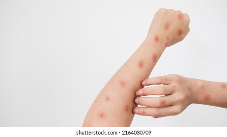 Concept of epidemic of monkey pox virus, white woman scratching skin, red rash, pustules and abscess, itching after being infected with monkeypox virus.