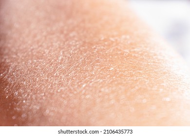 Concept of extremely dry and dehydrated skin of the body. Problematic skin diagnosed with xerosi or dermatitis. Close up of chapped arms and legs. Selective focus of a itchy skin. - Shutterstock ID 2106435773