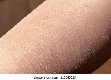 Concept of extremely dry and dehydrated skin of the body.  Close up of chapped arms and legs. Selective focus of a itchy skin. Diagnosis of xerosi, dermatitis, flaking skin. 