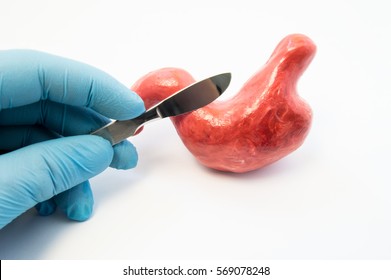 Concept of gastric surgery. Surgeon holding scalpel near anatomical model of stomach. Surgery operations and treatment of diseases of stomach same as ulcer, cancer, removal, reflux, bypass or sleeve - Shutterstock ID 569078248