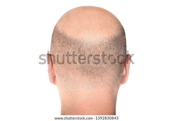 Concept Hair Loss Back View Balding Stock Photo Edit Now 1392830843