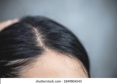 Concept Of Hair Loss.woman With Problematic Hair.