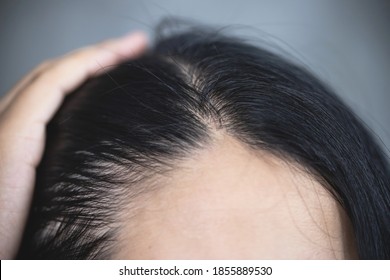 Concept Of Hair Loss.woman With Problematic Hair.