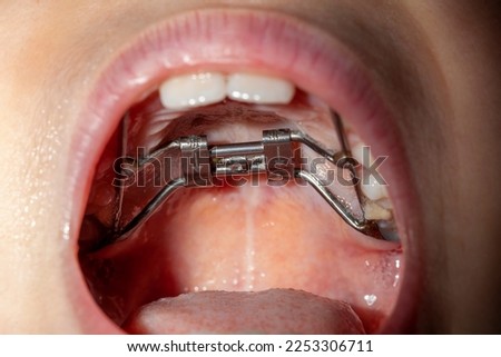 Concept image for orthodontic treatment for kids. Photo shows a palate expander placed on the upper jaw of a caucasian girl widening the narrow palate creating room for teeth.